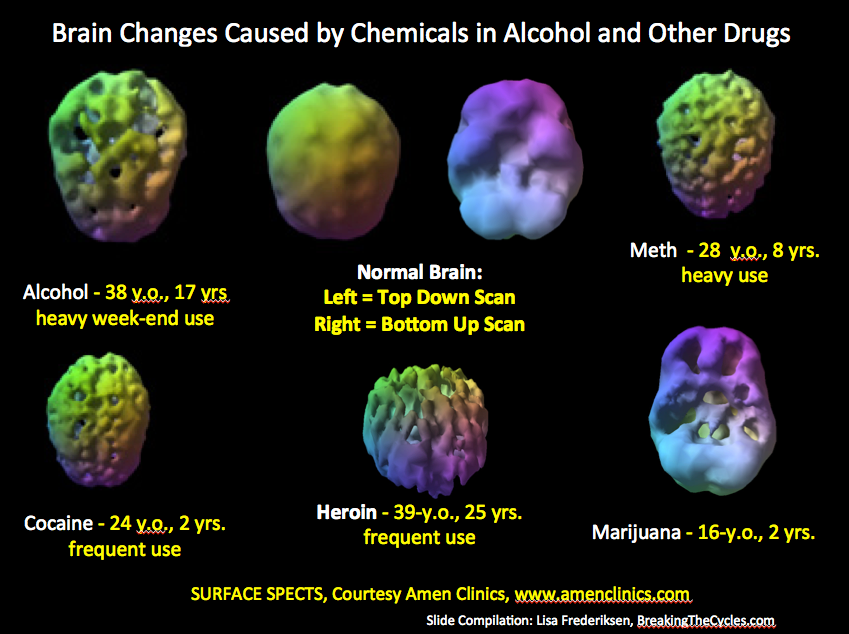 brain on drugs and alcohol