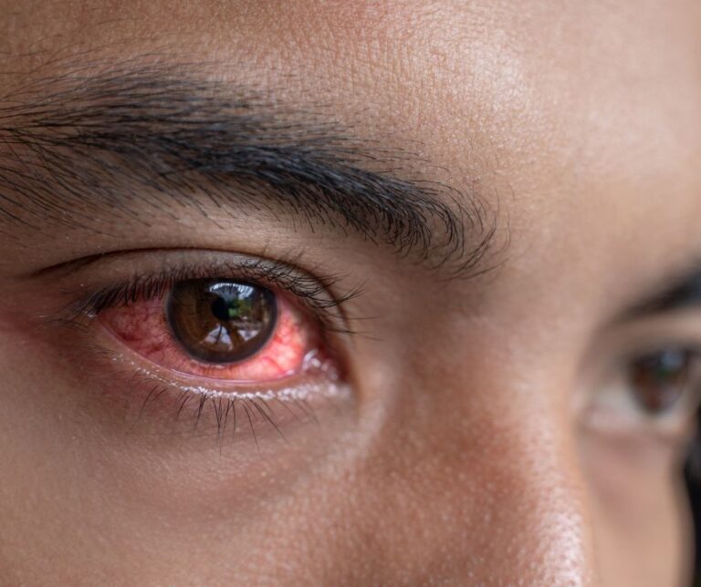 Eye allergy