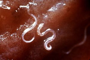 Hookworm Infection