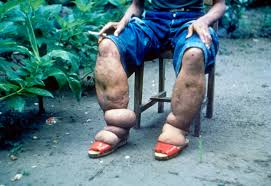 Lymphatic Filariasis