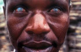 Onchocerca volvulus – Causes Onchocerciasis (River Blindness)