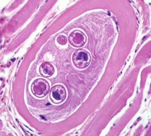 Trichinella spiralis Causes Trichinosis