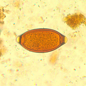 Trichuriasis